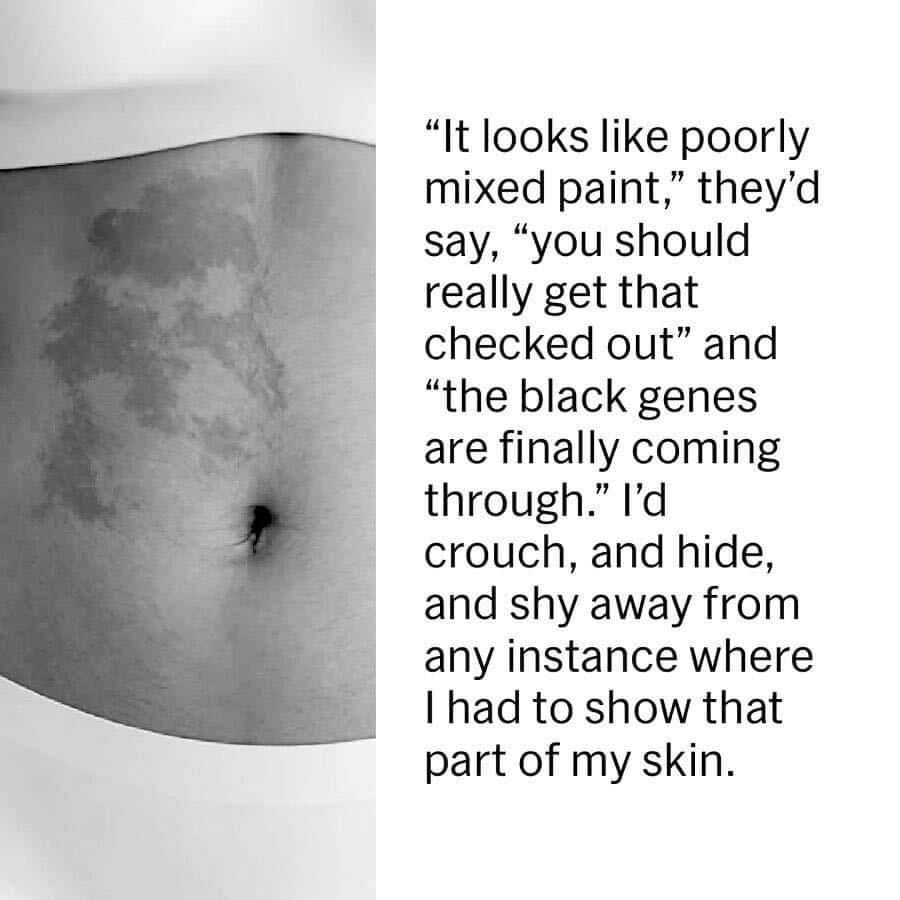 Dana Bryce recounts her experience as someone of mixed heritage. People used to make comments about her dark birth mark, which she shows in a photo.